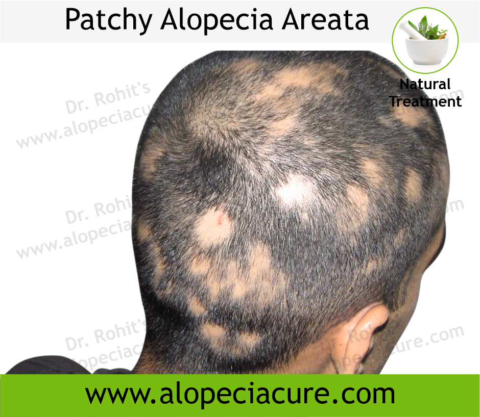 Primary Alopecia Areata